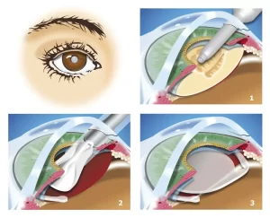 Cataracty Eye Surgery